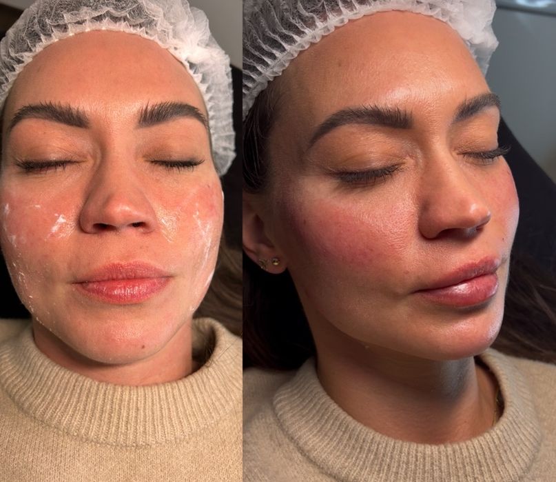 Kwas hialuronowy, botox