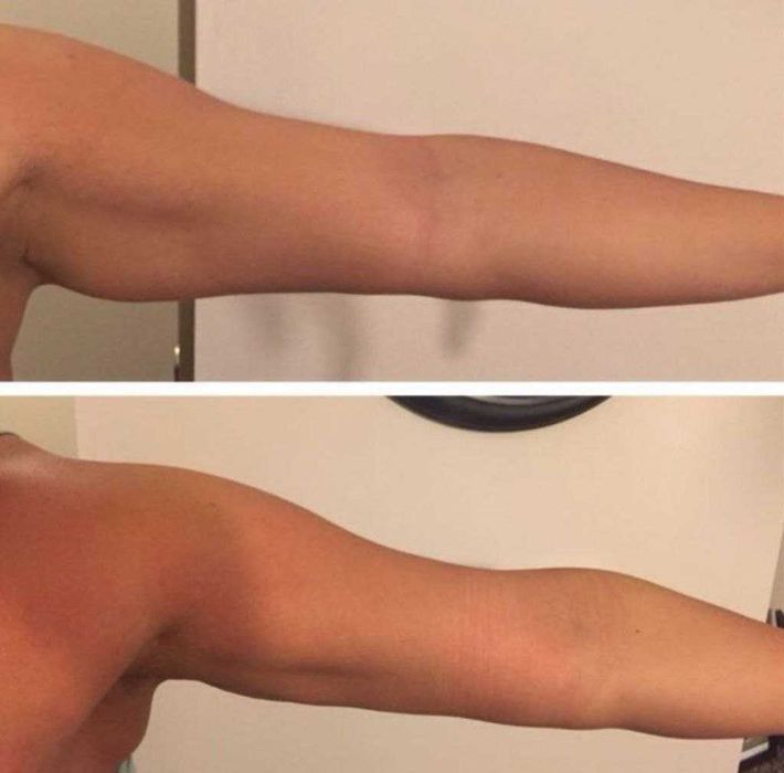 Антицелюлітний вакуумний масаж  • Апаратні методики • Масаж обличчя