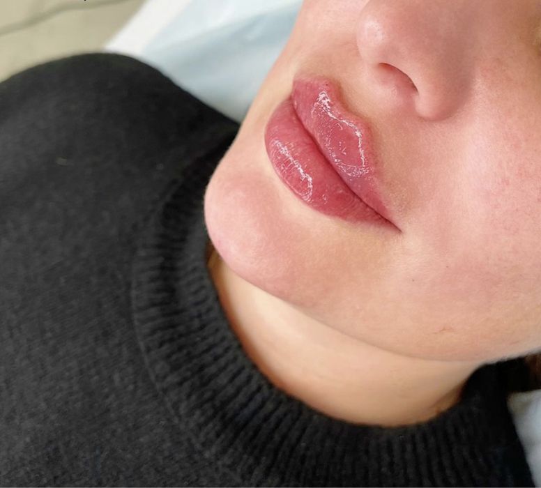 Powiekszanie ust PROMOCJA !!! Botox 200 zl