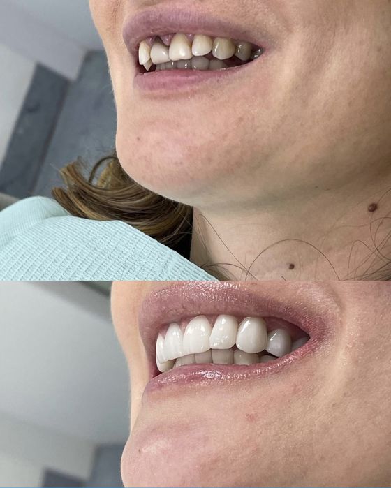 Керамічні вініри. Київ, 13500 грн . Акція! ВСЕ ВКЛЮЧЕНО!!! Е.max