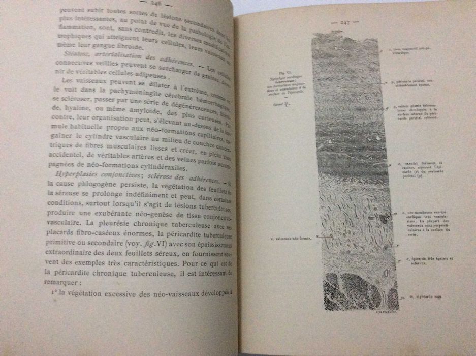 Raro exemplar. LETULLE, Maurice (1853-1929): L'Inflammation. Études anatomo-pathologiques. Rubricado pelo médico António de Padua