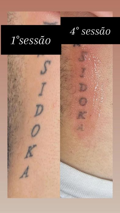 Vendo máquina de laser 3 ondas