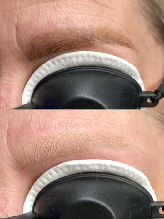 Видалення татуажа тату перманента лазером бровей стрелок губ ремувер