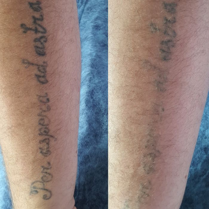 Удаление тату, Удаление татуажа, удаление перманента