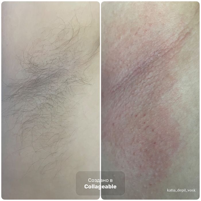 Депіляція віск Депиляция Воск Чернігів УЗ чистка обличчя