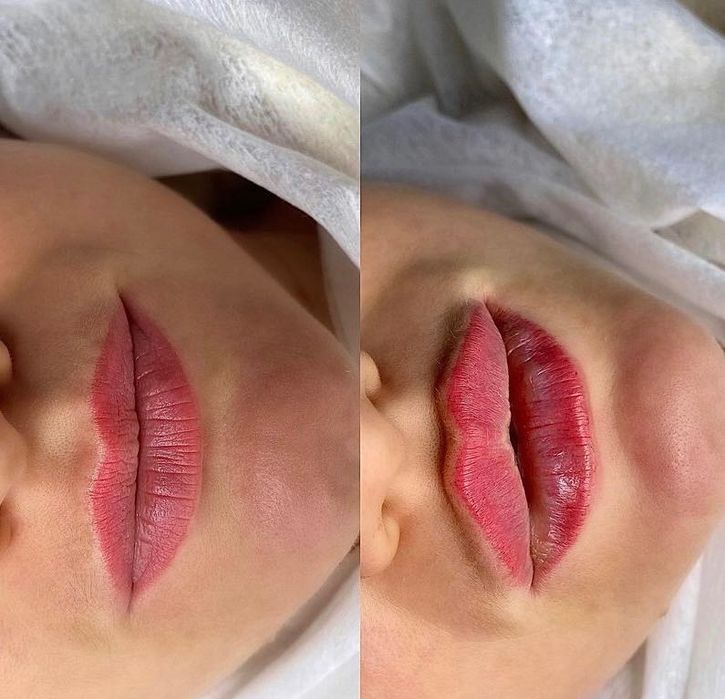 Косметолог ! Інʼєкційні процедури! Запоріжжя!