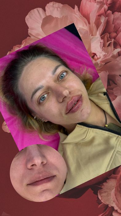 Увеличения Губ Контурная пластика,ботокс