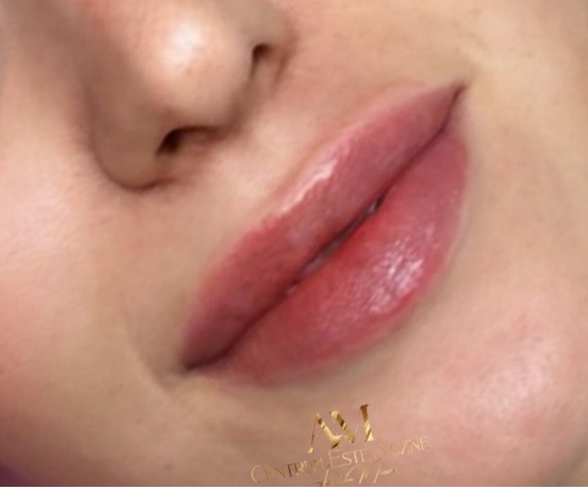Kwas hialuronowy, botox