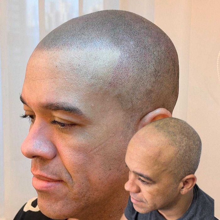 Micropigmentação capilar.