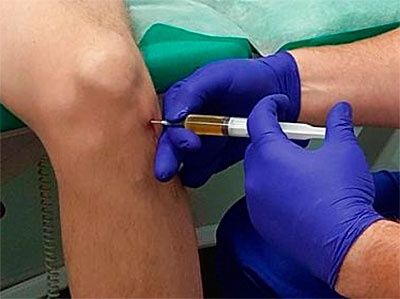 Лікування захворювання суглобів хребта, PRP терапія.