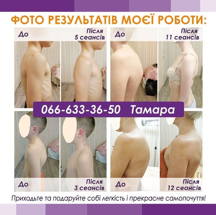 Масаж массаж сколіоз кіфоз