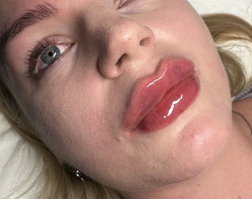 Usta na płasko, BTX, mezoterapia, lipoliza