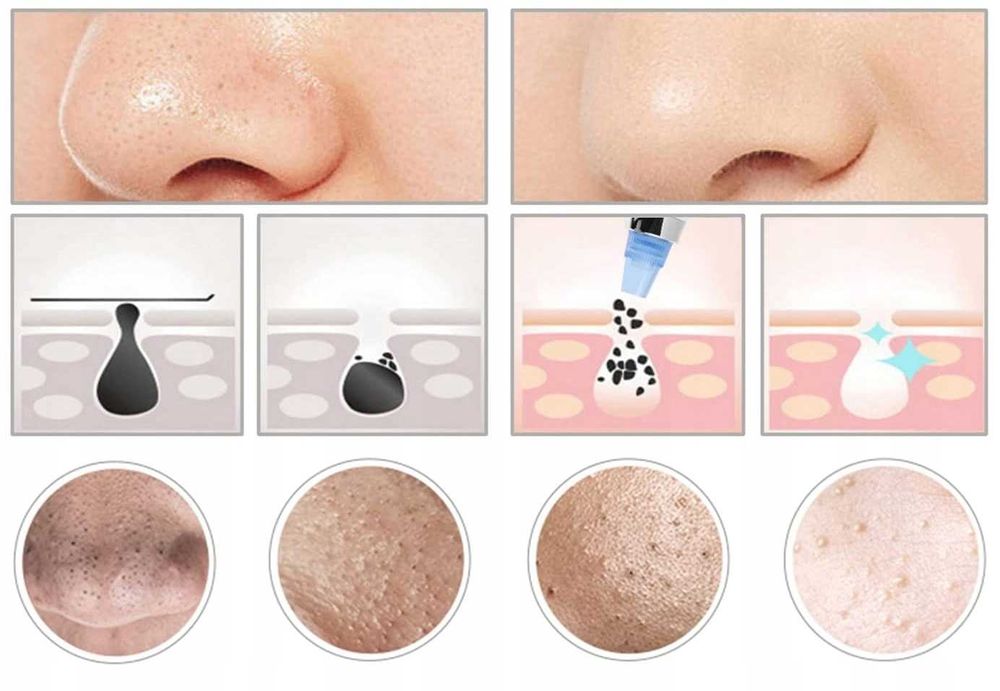 Odkurzacz do wągrów usuwanie zaskórników