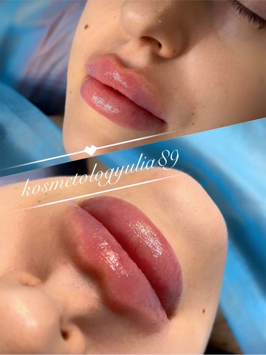 Увеличение губ от 2300 грн Sardenya Deep