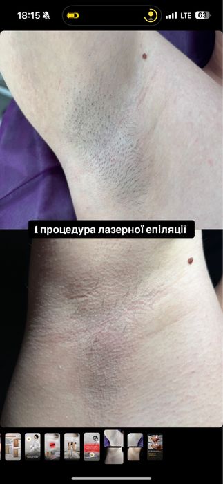 ПРОДАМ ПО МІНІМАЛЬНІЙ ЦІНІ! Діодний лазер  для епіляції!