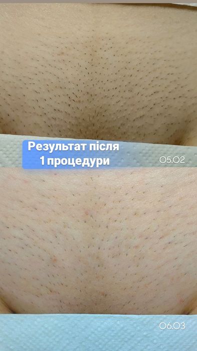 Лазерна епіляція "все тіло" - 800грн