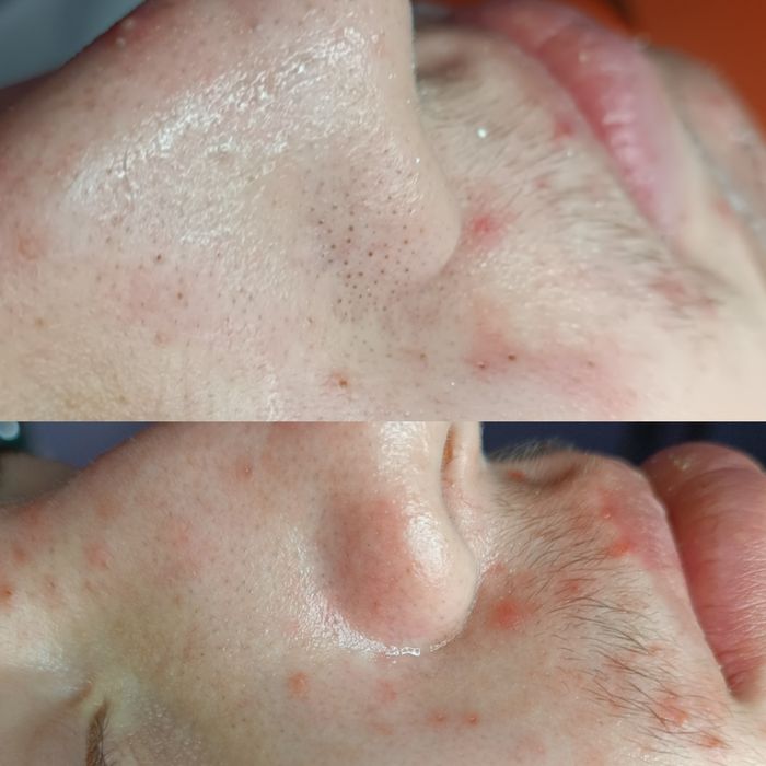 Косметолог Чистка лица Пилинг Rf лифтинг