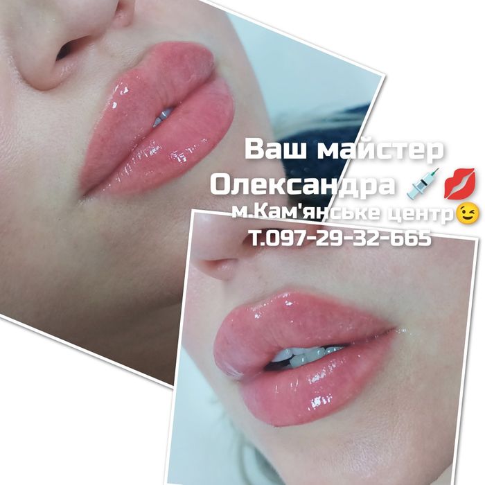 Косметолог. Контурна пластика губ, мезотерапія, біоре-ція, ліполітик.