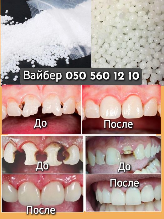 Полимерный гель для зубов, реставрация зубов