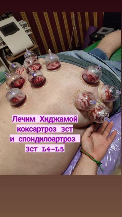 Обучение Хиджаме Харьков индивидуально и группой,  лично и онлайн