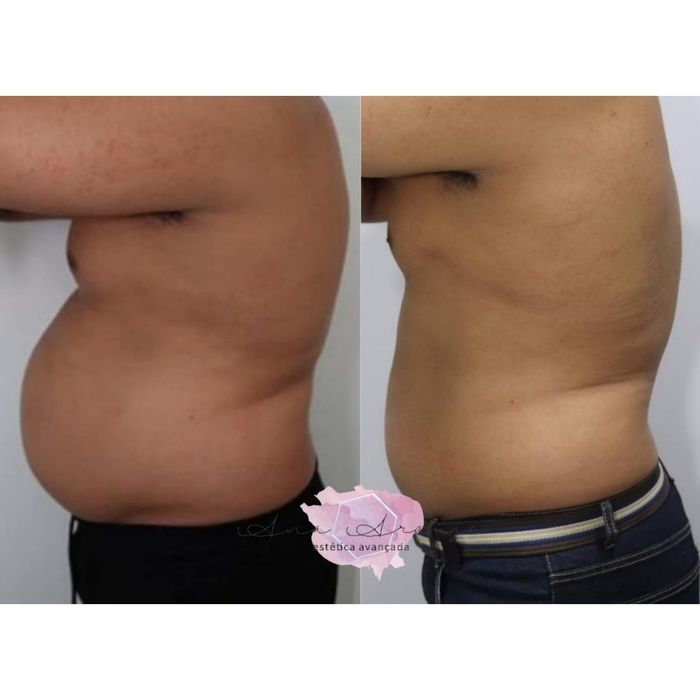 Criolipolise (tratamento para gordura)