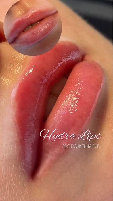 Мікронідлінг губ HYDRA LIPS - Безінʼєкційне зволоження!