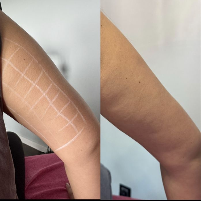 Mezoterapia efekt btx modelowanie powiekszane ust kwas hialuronowy