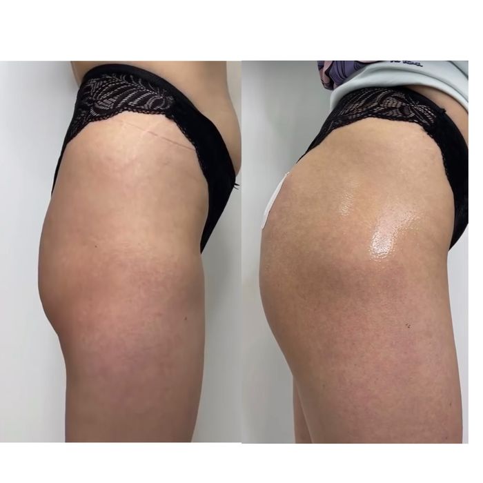 Увеличение губ. Контурная пластика. Губы. Ботокс.Нити.Фулфейс