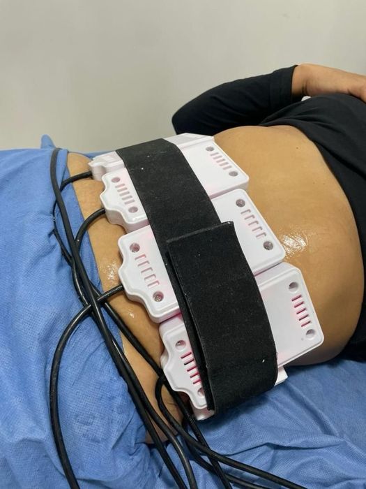 Апаратний масаж кавітація, вакум, RF ліфтінг, лазерний ліполіз