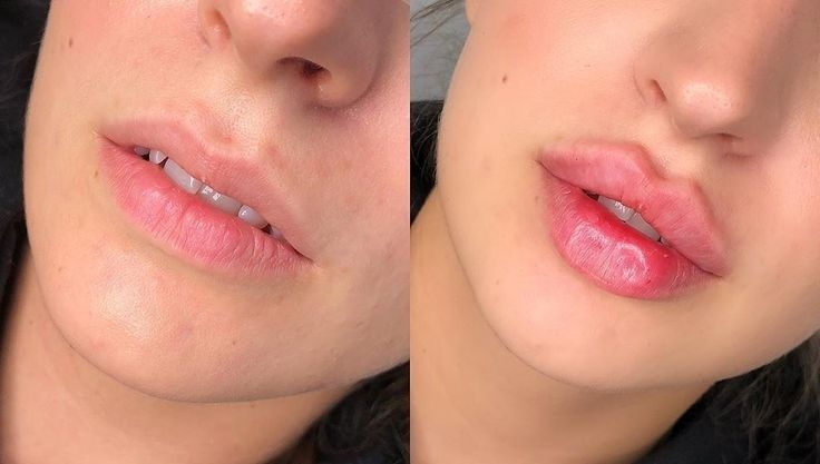 АКЦИЯ!!! Увеличение губ 1700 грн. Колличество мест ограничено!