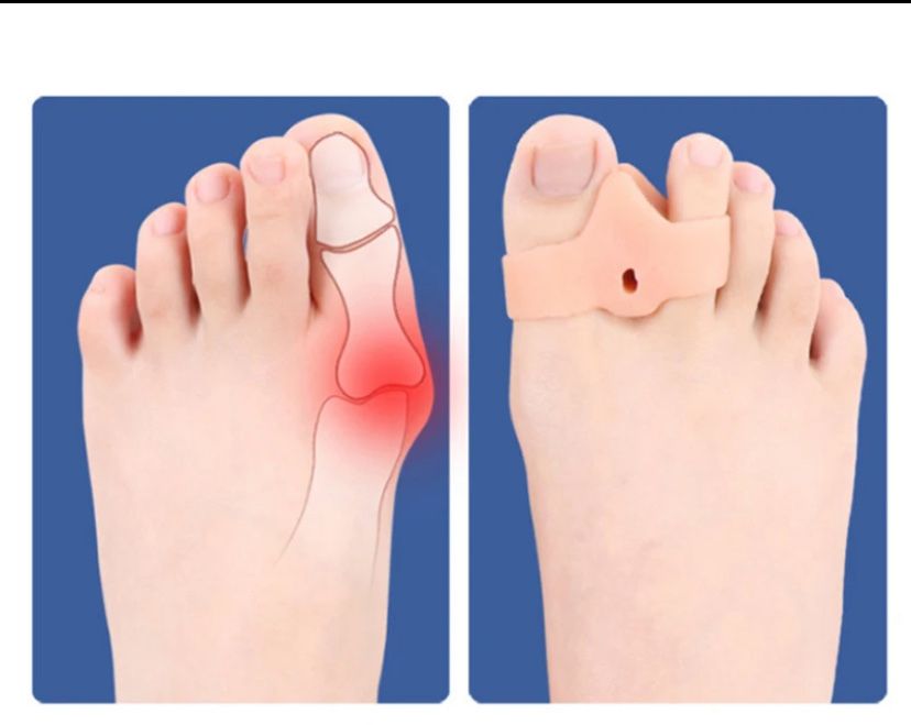 Corretor de joanete, dedo dos pés o par produto de silicone