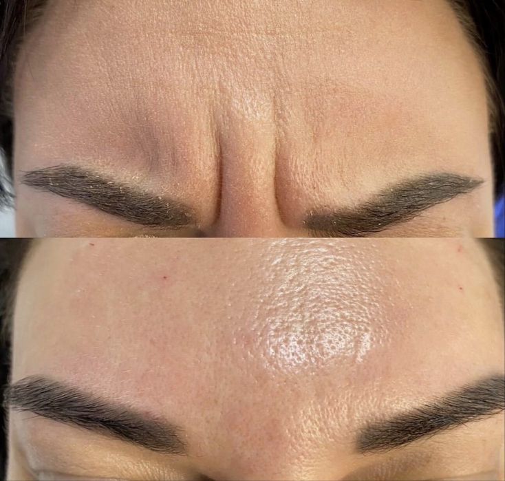 Ботокс! Ботулінотерапія