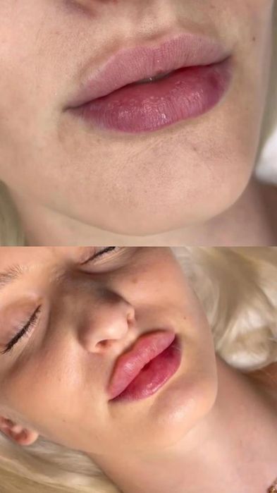 Увеличение губ ,индивидуальный подход. Сертифицированные препараты