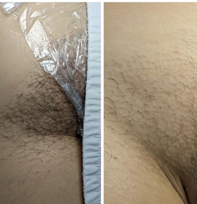 Електроепіляція, депіляція, шугаринг Вінниця