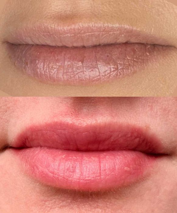 Micropigmentação Labial & Despigmentação Laser - Figueira da Foz