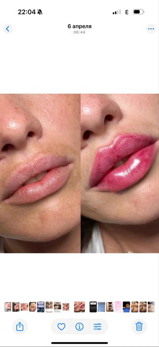 Увеличение губ. Контурная пластика. Губы. Ботокс.Нити.Фулфейс