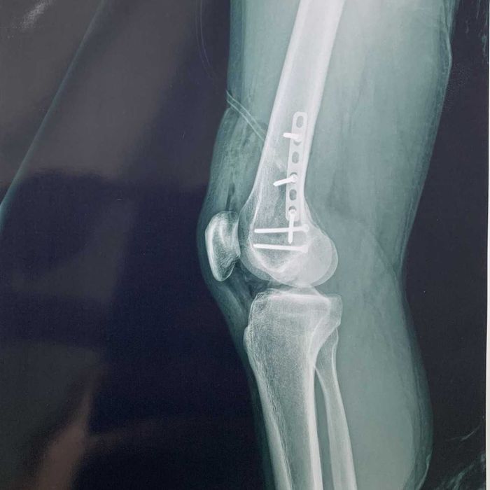 Титанова пластина та шурупи