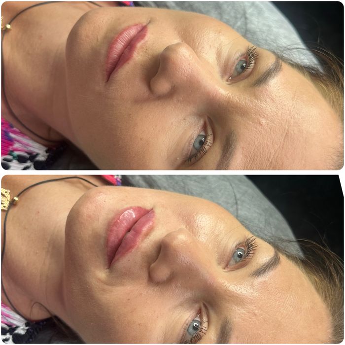 Увеличение губ и ботокс