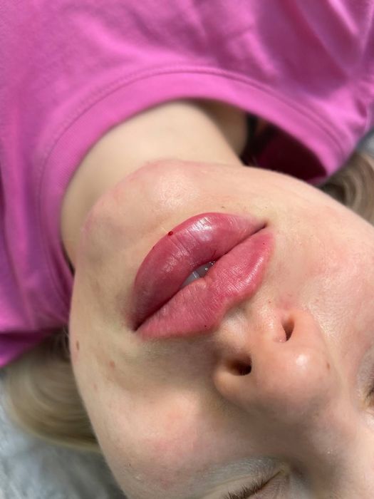 Косметолог моделі на(губи,ботокс,смас,рф голка,схуднення,худе обличчя)