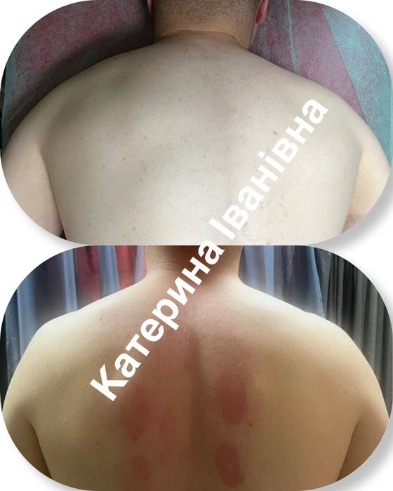 Масаж  та реабілітація!Стоун терапія лімфодренаж пресотерапія