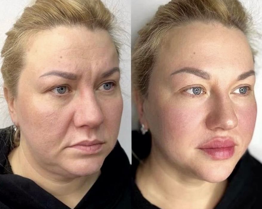 Ботокс. Контуринг. Увеличение губ. Нитевой лифтинг.Биоревитализация