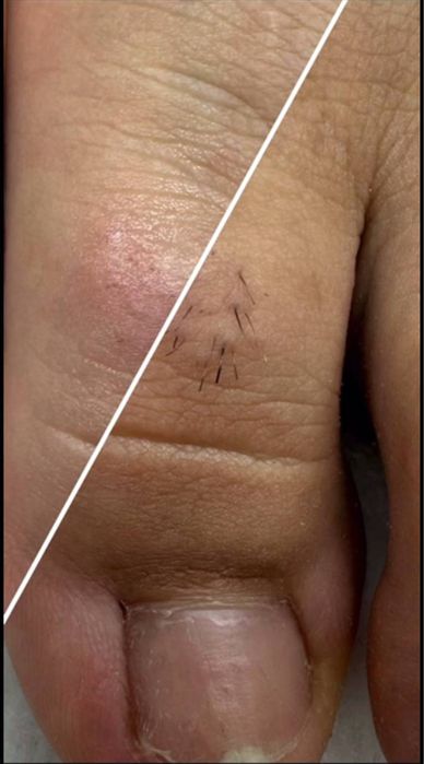 Электроэпиляция, поселок Котовского