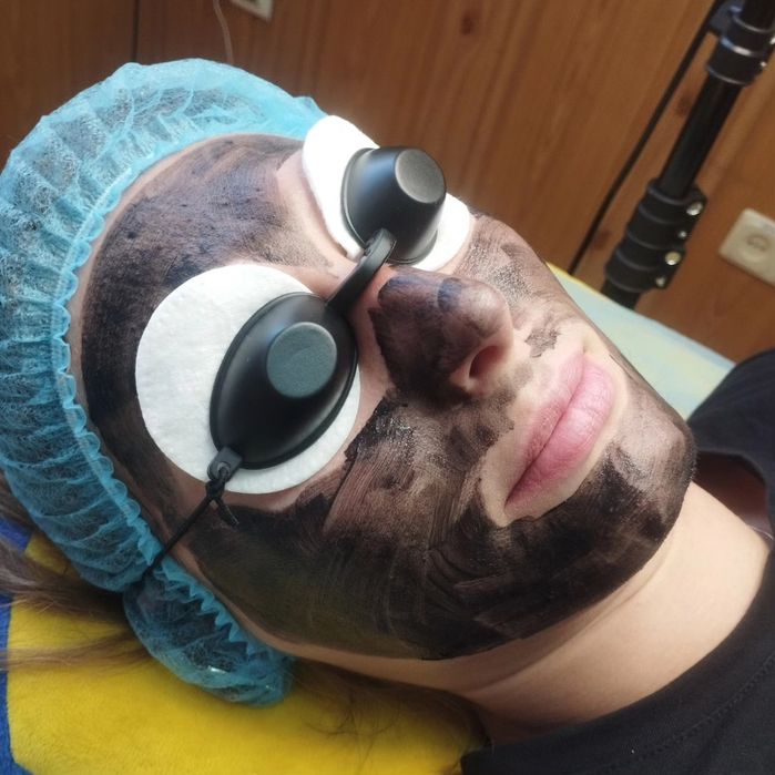 Карбоновий пілінг