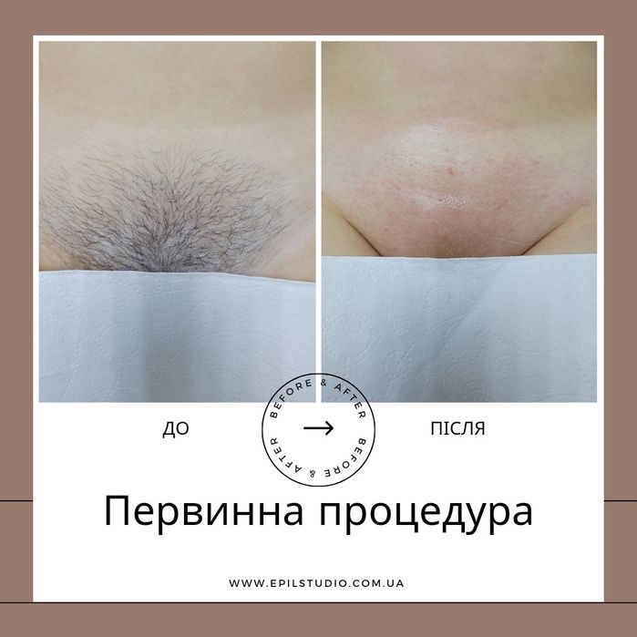 Епіляція воскова, цукрова, лікування врослого волосся