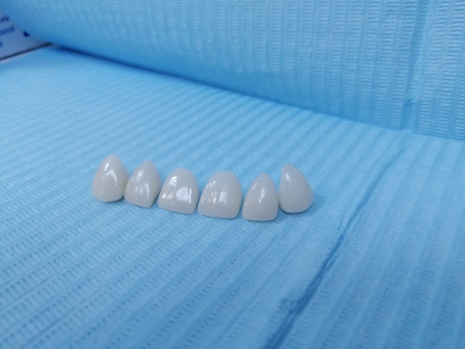 Керамічні вініри. Київ, 13500 грн . Акція! ВСЕ ВКЛЮЧЕНО!!! Е.max