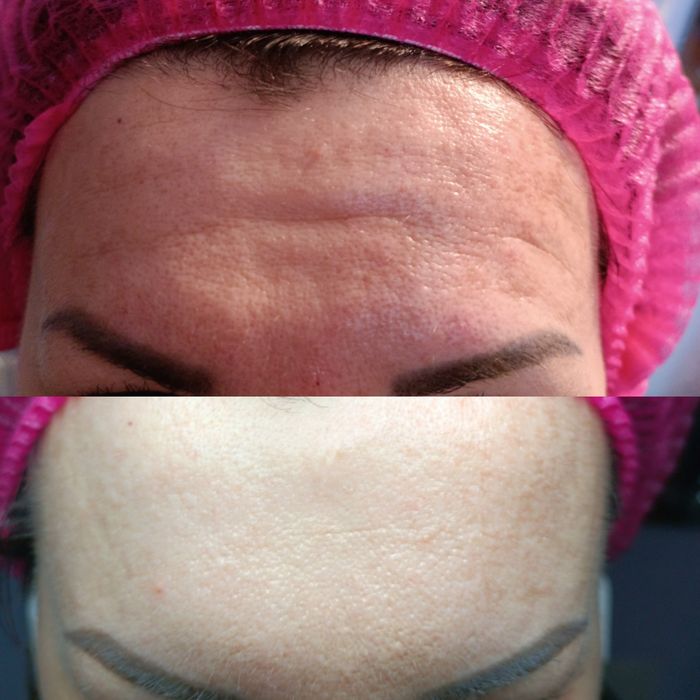 Косметолог Чистка лица Пилинг Rf лифтинг