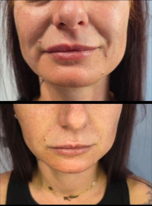 Promocja botox 1 okolica 150zł , usta 370