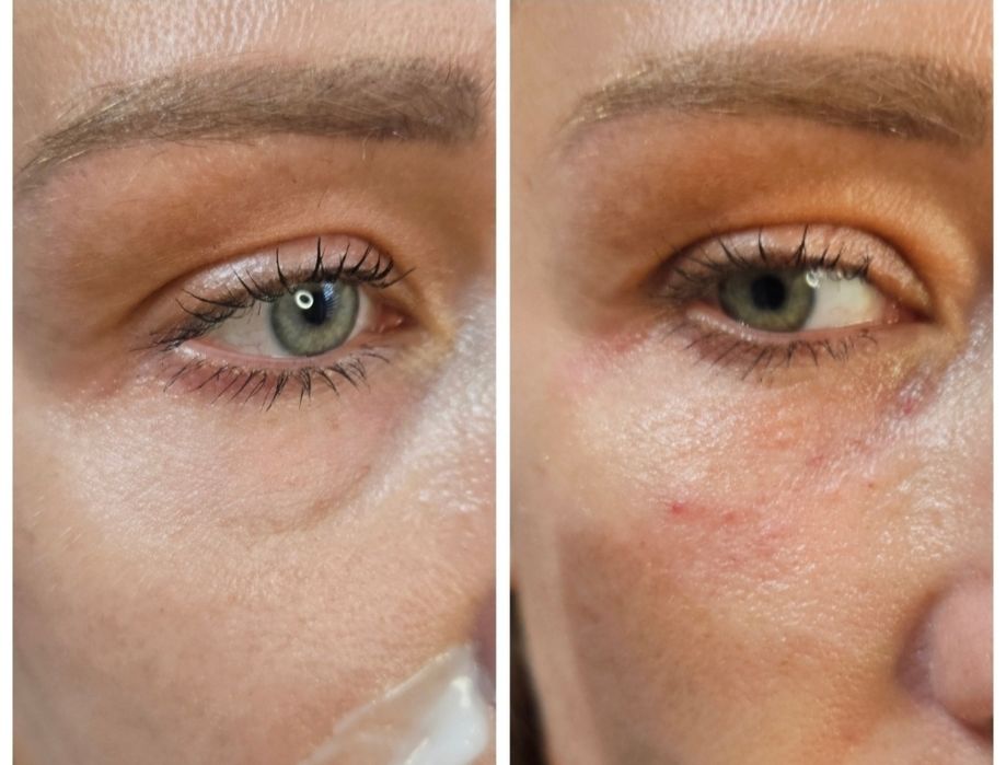 Promocja! Botox promocja 1 okolice 130zł do końca sierpnia