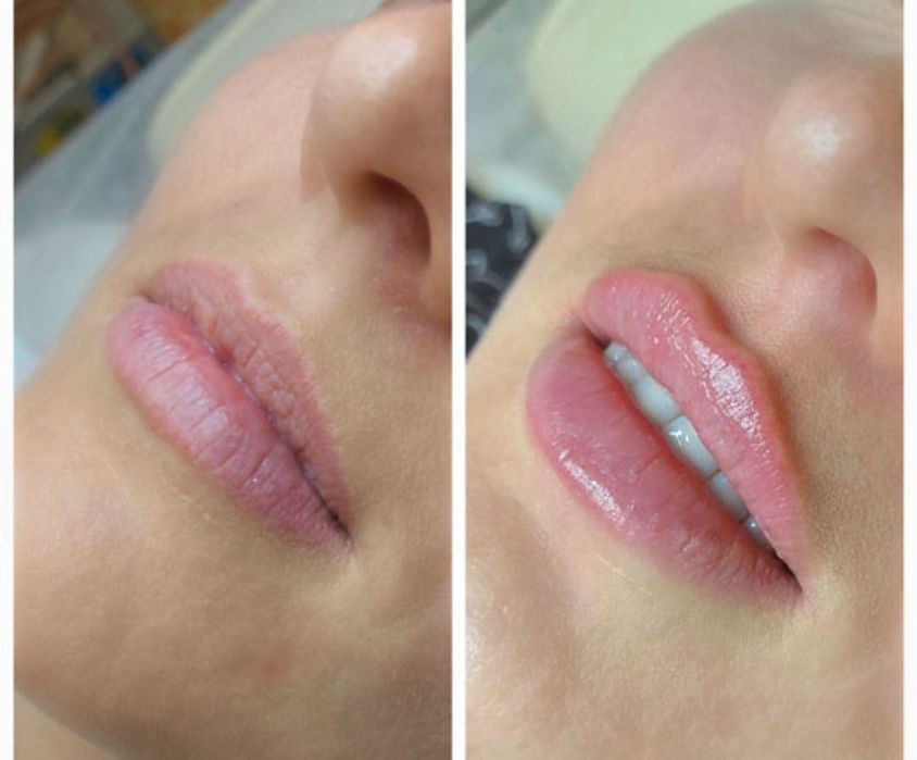 Usta/botox/mezoterapia