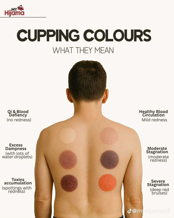 АРАБСЬКА ХІДЖАМА - вакуумна терапія